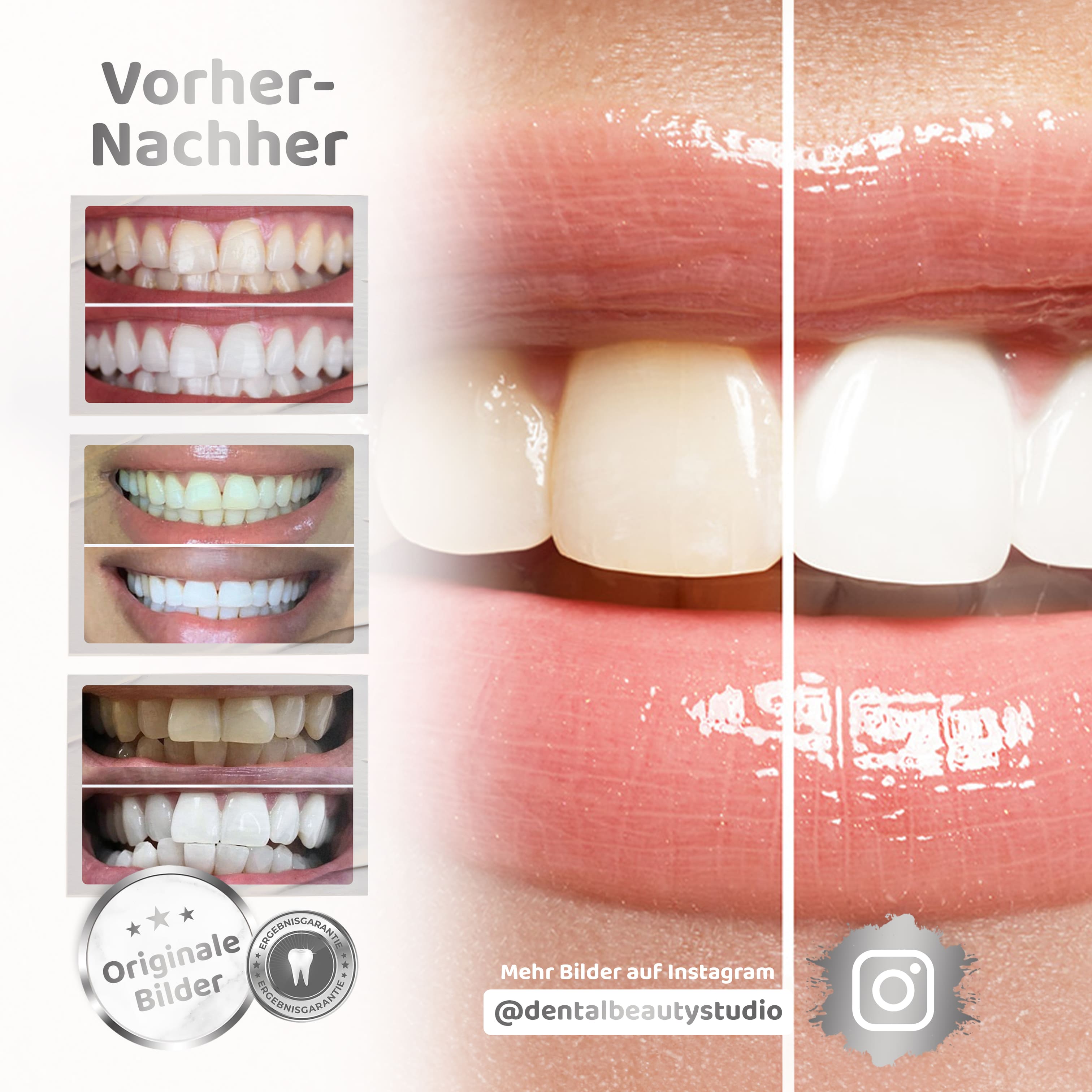 Kit de blanqueamiento dental Rapid+ Dental Beauty